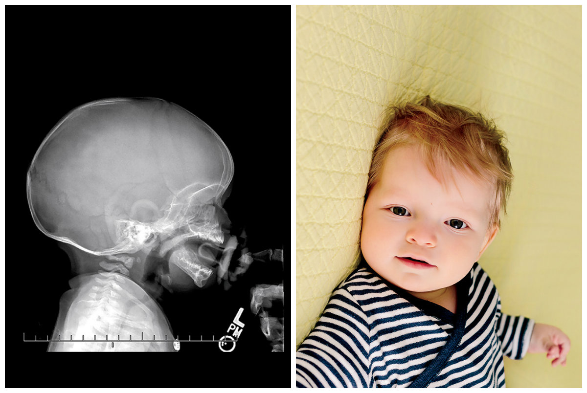 Found out today that he doesn't have craniosynostosis and doesn't need  incredibly invasive surgery. Whew! : r/Parenting